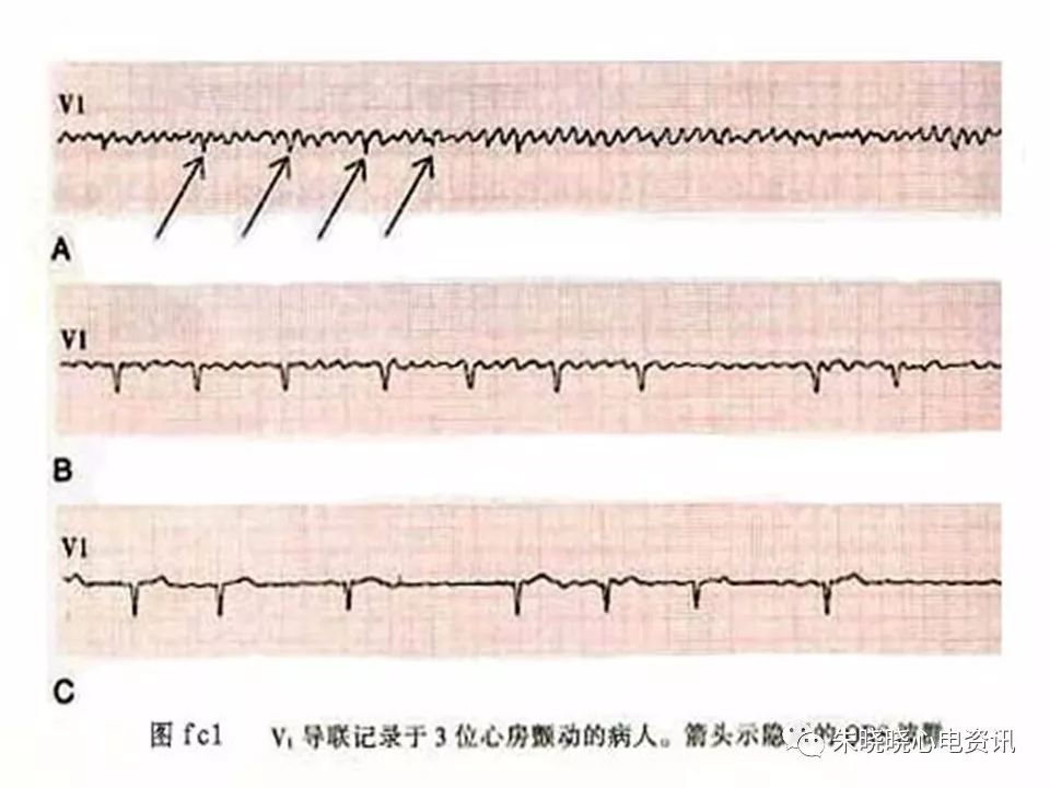 心电图危急值识别与诊断，这篇一定要收藏！