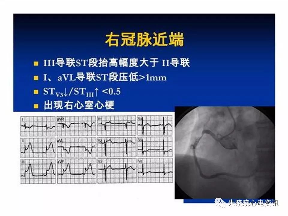 心电图危急值识别与诊断，这篇一定要收藏！