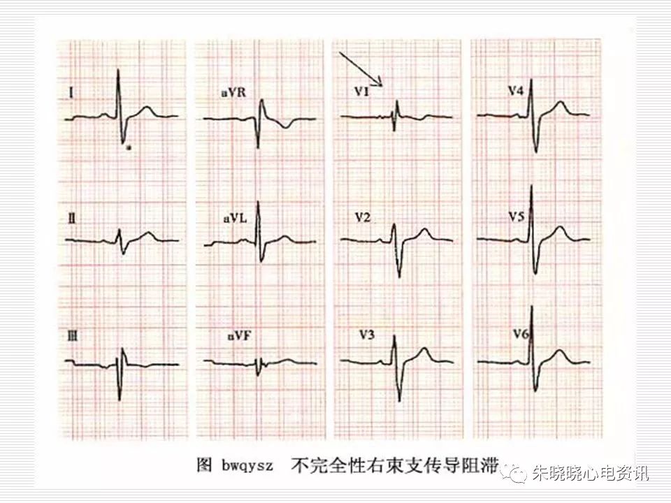 心电图危急值识别与诊断，这篇一定要收藏！