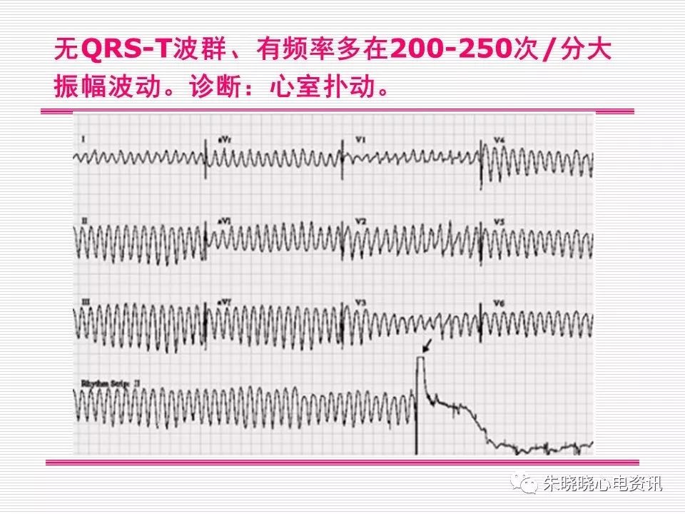 心电图危急值识别与诊断，这篇一定要收藏！
