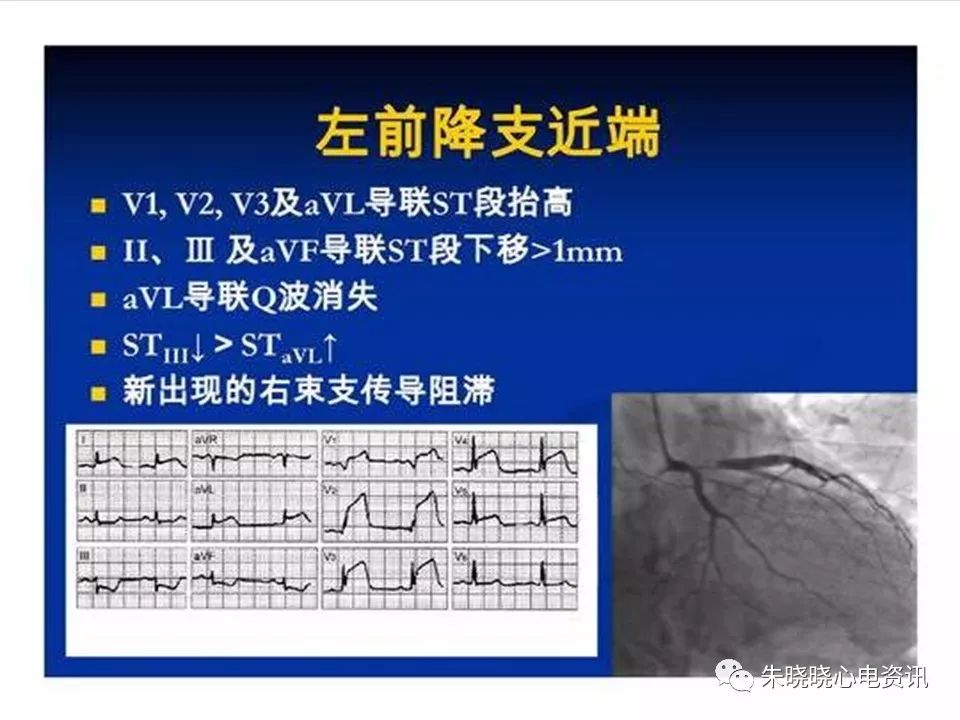 心电图危急值识别与诊断，这篇一定要收藏！