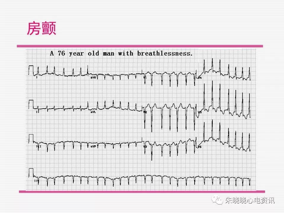 心电图危急值识别与诊断，这篇一定要收藏！