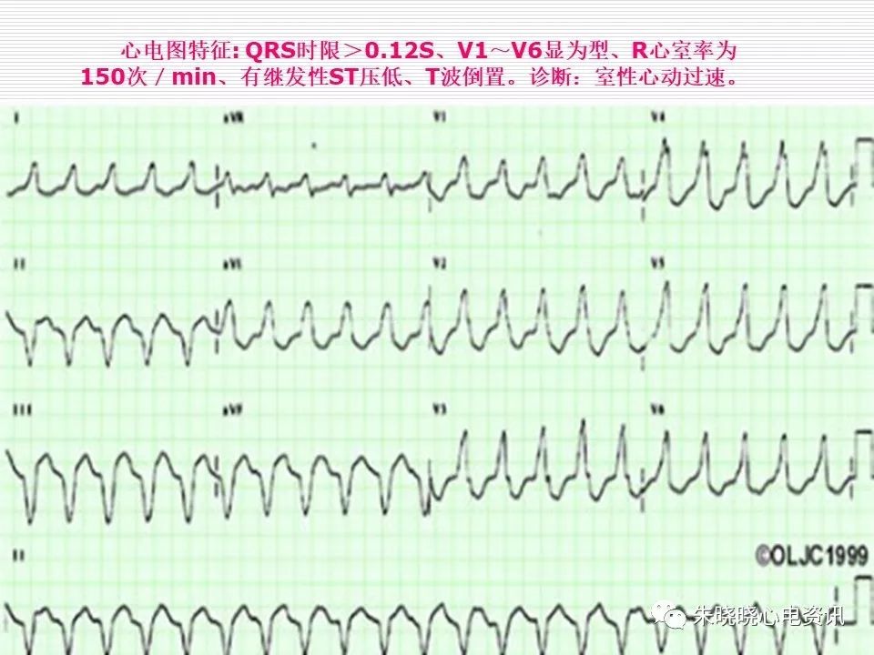 心电图危急值识别与诊断，这篇一定要收藏！