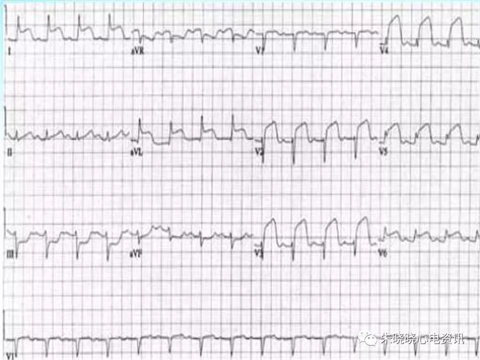 心电图危急值识别与诊断，这篇一定要收藏！