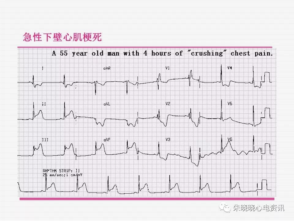 心电图危急值识别与诊断，这篇一定要收藏！