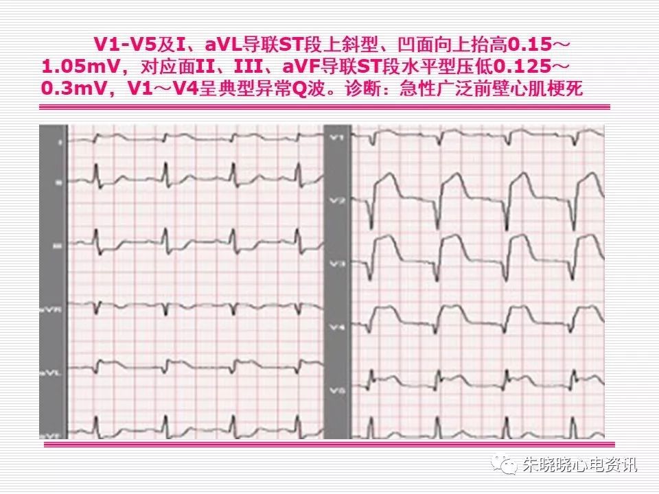 心电图危急值识别与诊断，这篇一定要收藏！