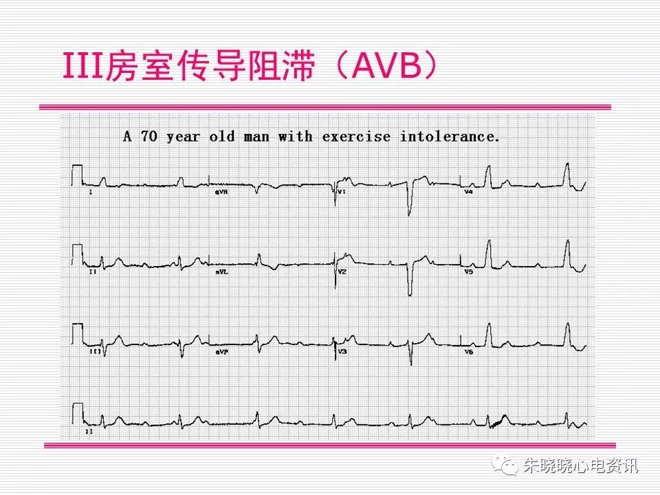 心电图危急值识别与诊断，这篇一定要收藏！