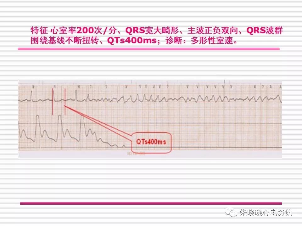 心电图危急值识别与诊断，这篇一定要收藏！