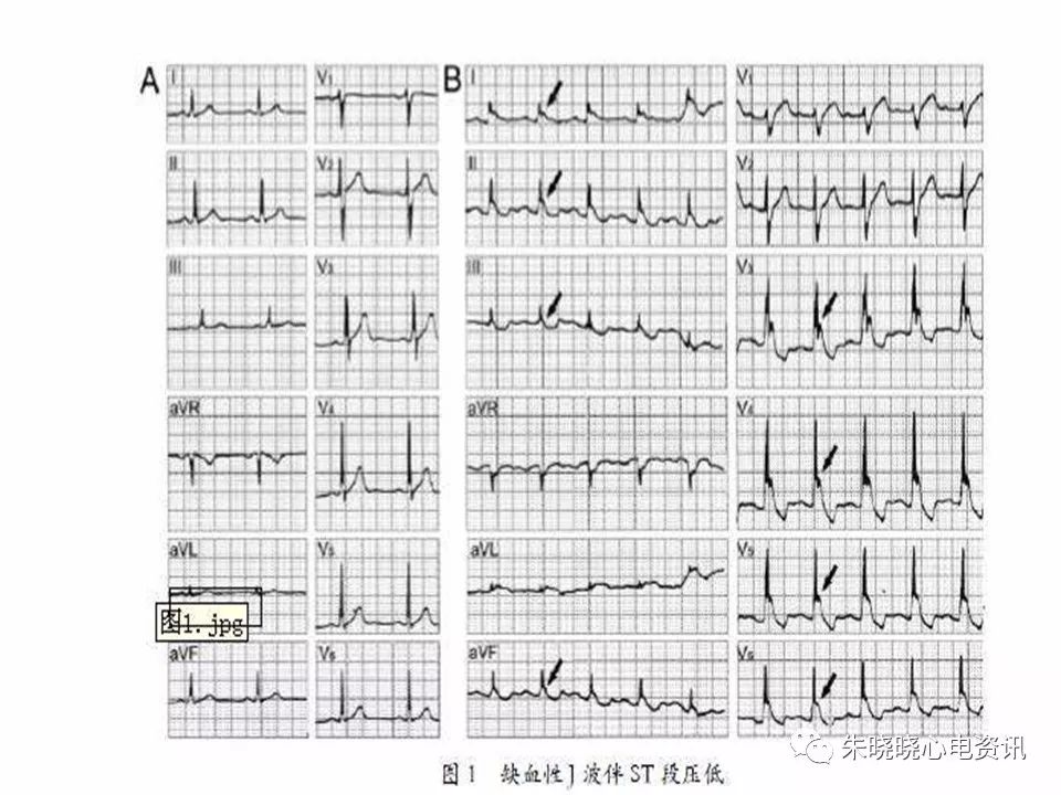 心电图危急值识别与诊断，这篇一定要收藏！
