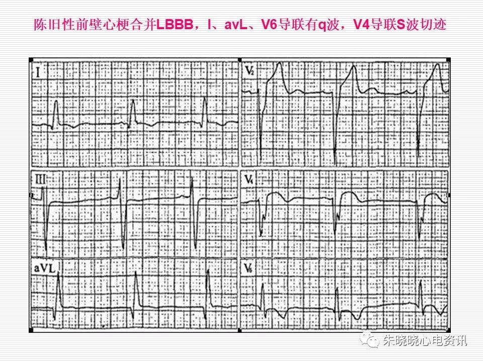 心电图危急值识别与诊断，这篇一定要收藏！