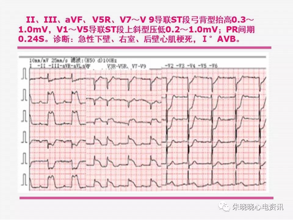 心电图危急值识别与诊断，这篇一定要收藏！