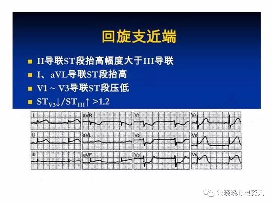 心电图危急值识别与诊断，这篇一定要收藏！