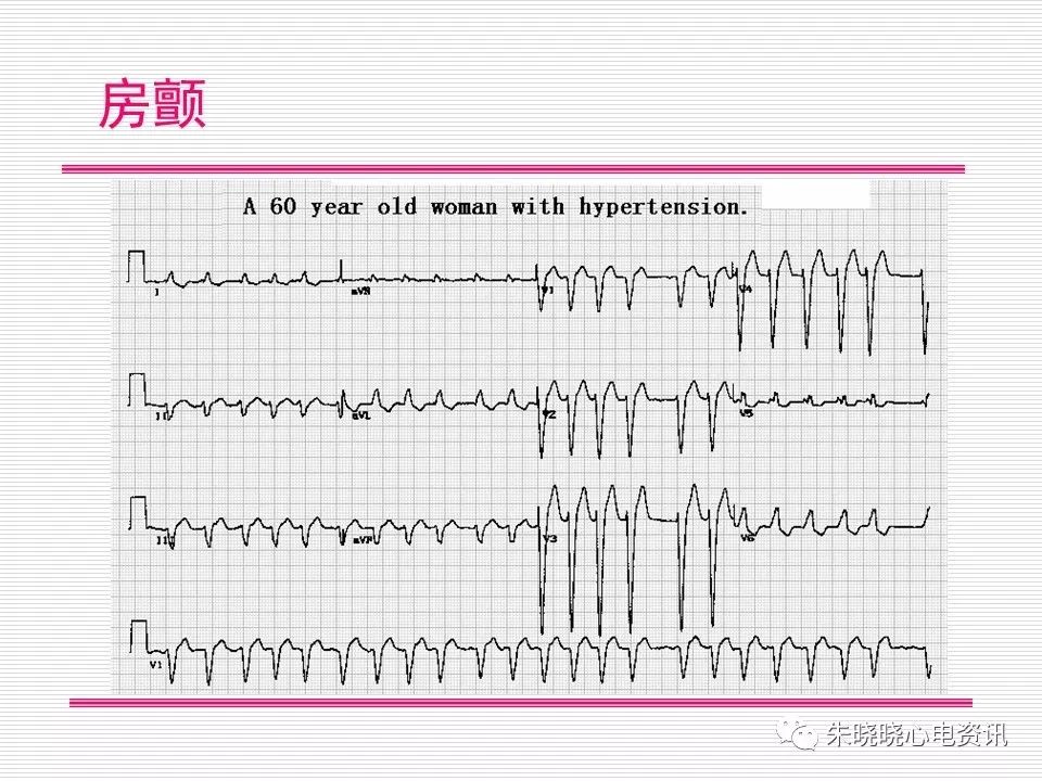 心电图危急值识别与诊断，这篇一定要收藏！
