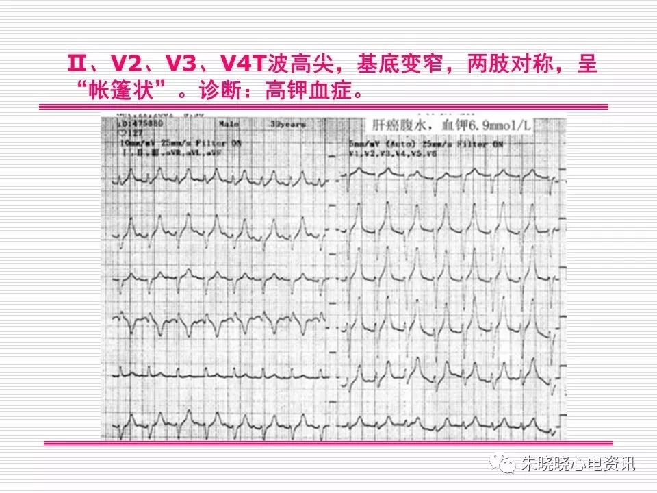 心电图危急值识别与诊断，这篇一定要收藏！
