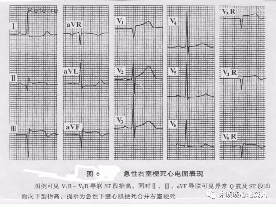 心电图危急值识别与诊断，这篇一定要收藏！