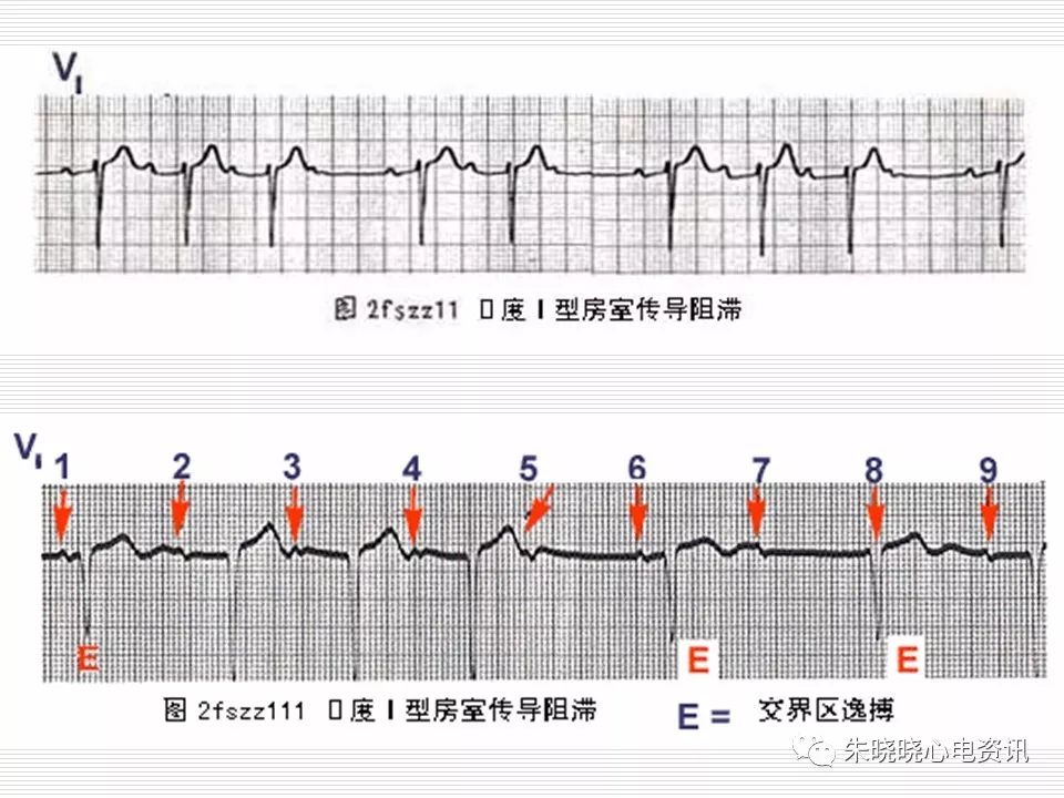 心电图危急值识别与诊断，这篇一定要收藏！