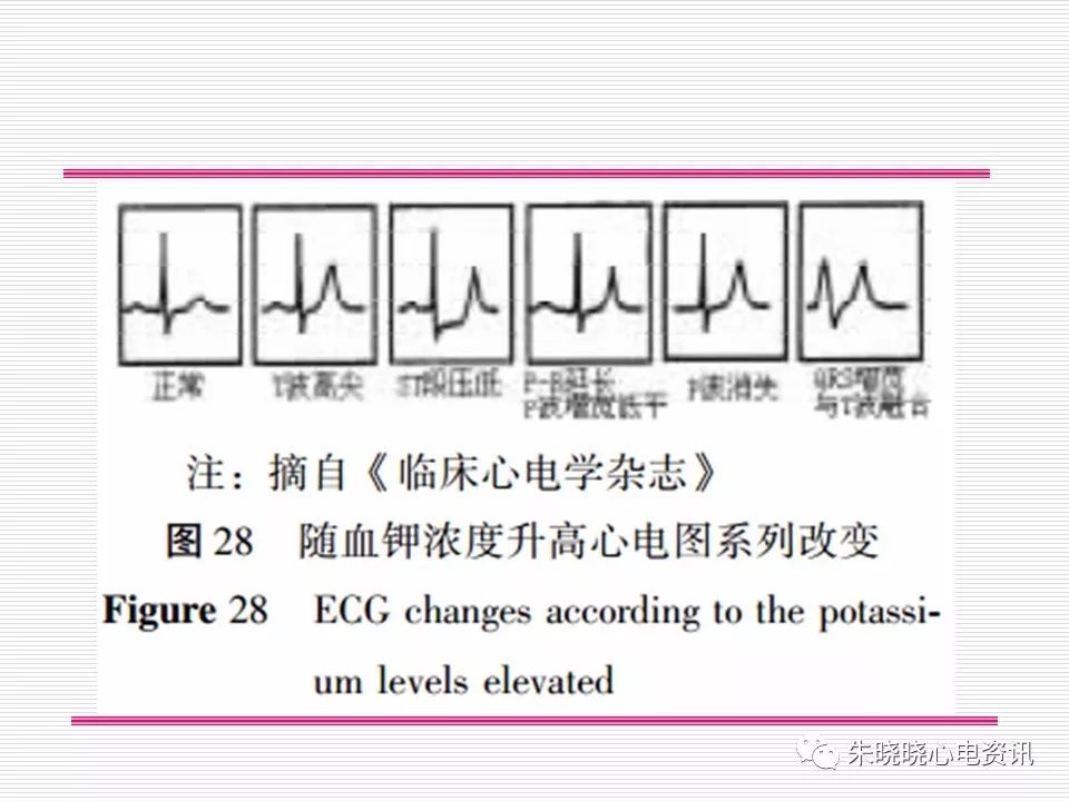 心电图危急值识别与诊断，这篇一定要收藏！