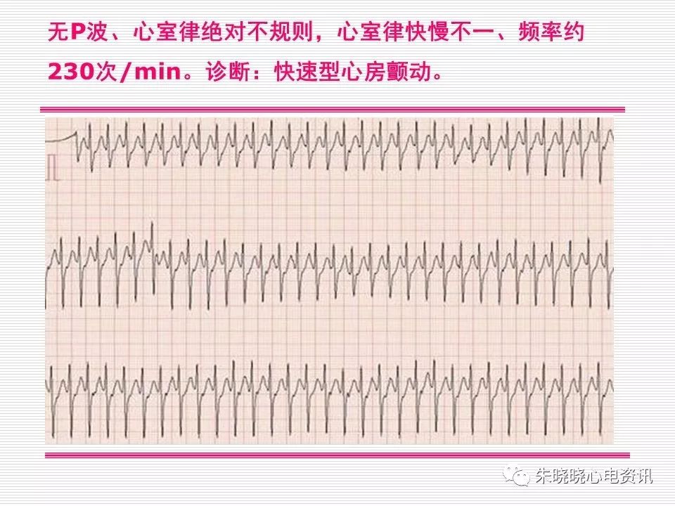 心电图危急值识别与诊断，这篇一定要收藏！
