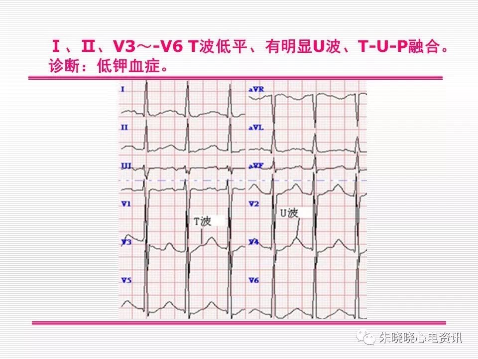 心电图危急值识别与诊断，这篇一定要收藏！