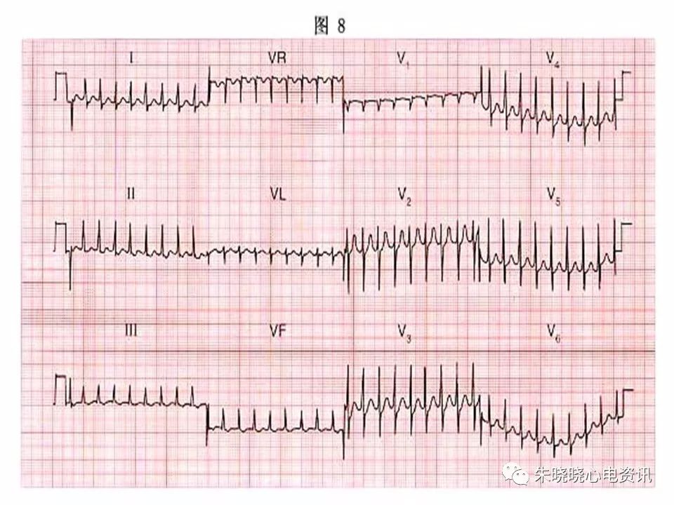 心电图危急值识别与诊断，这篇一定要收藏！
