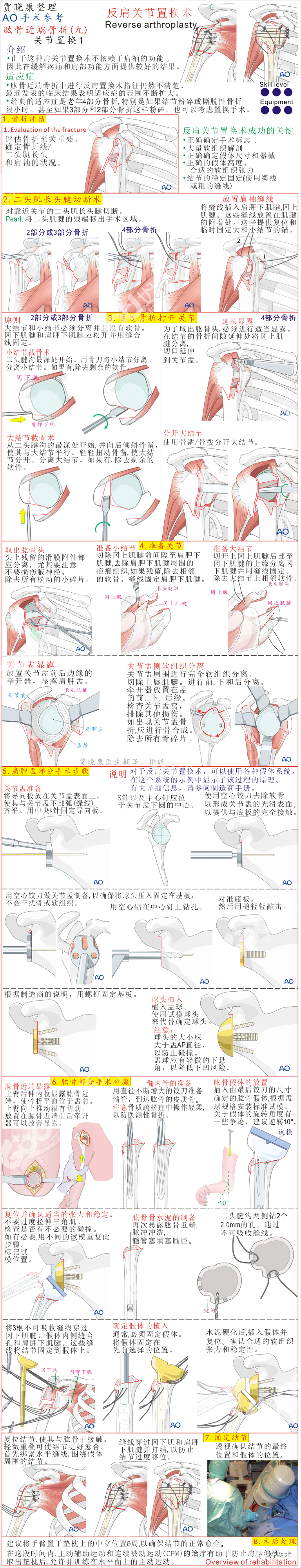 手术必备：15张超清知识卡片，全方位掌握肱骨近端骨折！