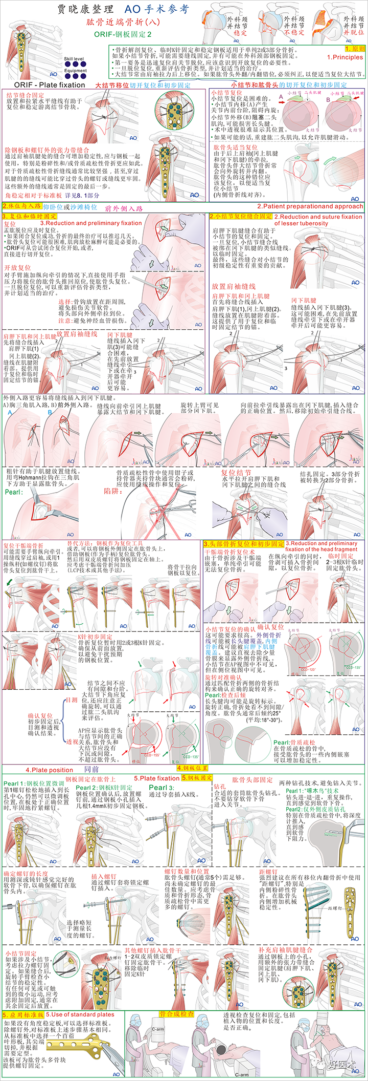 手术必备：15张超清知识卡片，全方位掌握肱骨近端骨折！