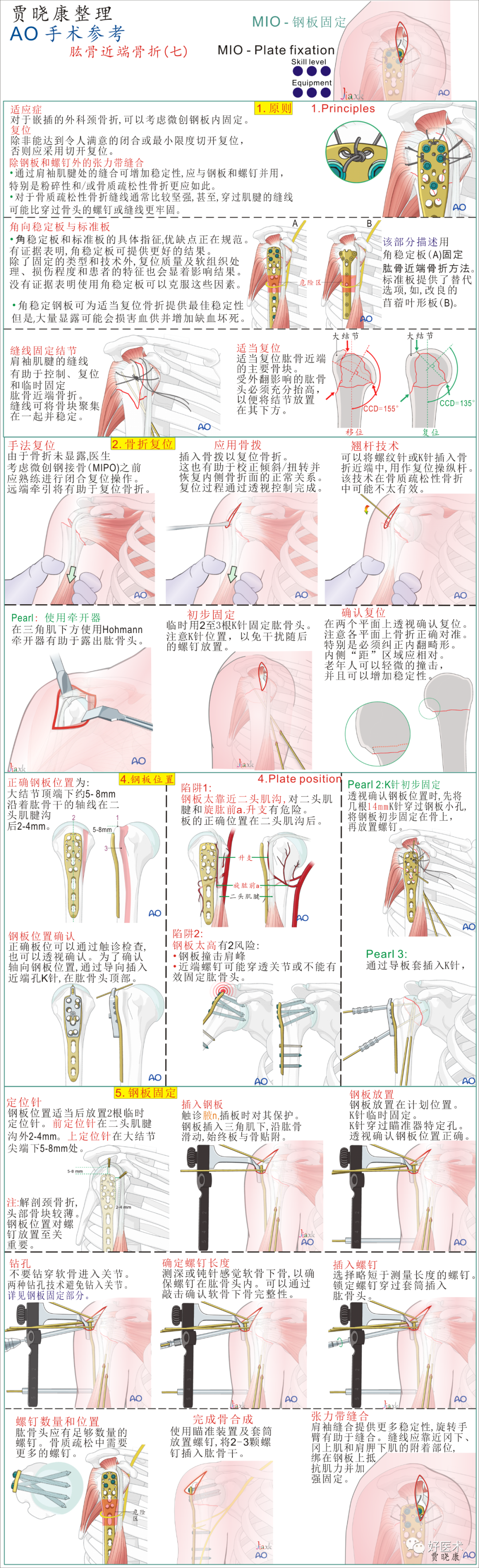 手术必备：15张超清知识卡片，全方位掌握肱骨近端骨折！