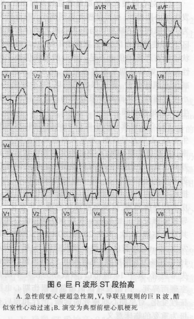 ST-T改变，除了心梗你还能想到多少种原因？