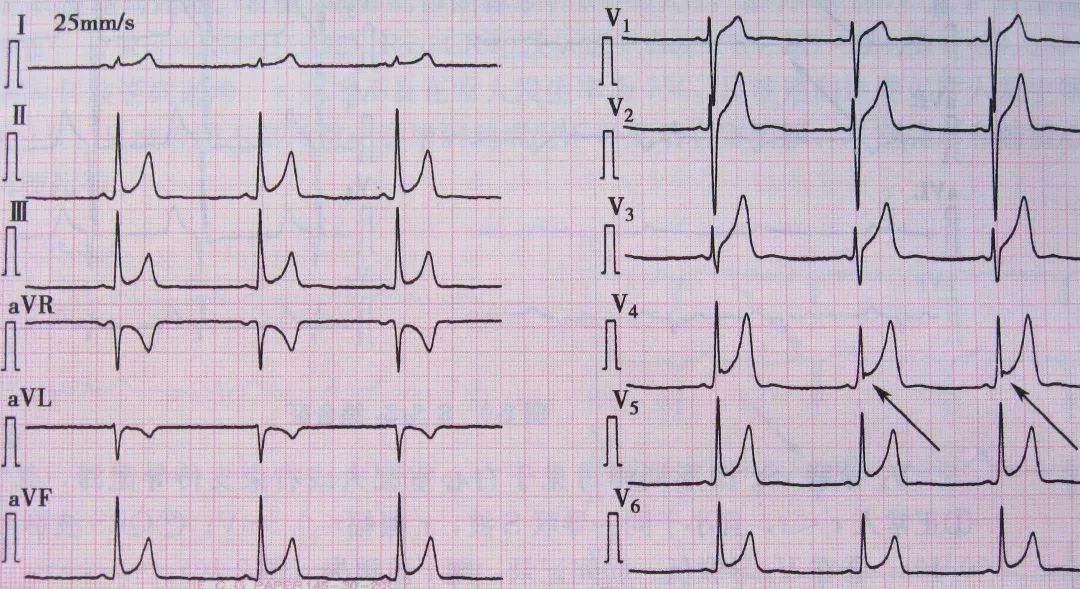 ST-T改变，除了心梗你还能想到多少种原因？