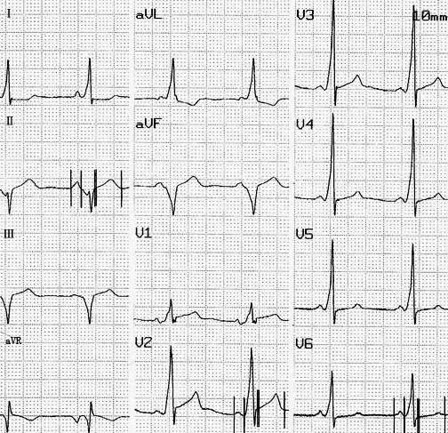 ST-T改变，除了心梗你还能想到多少种原因？