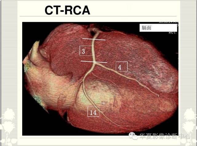 冠脉解剖与CTA，多图好记！这篇一定要收藏