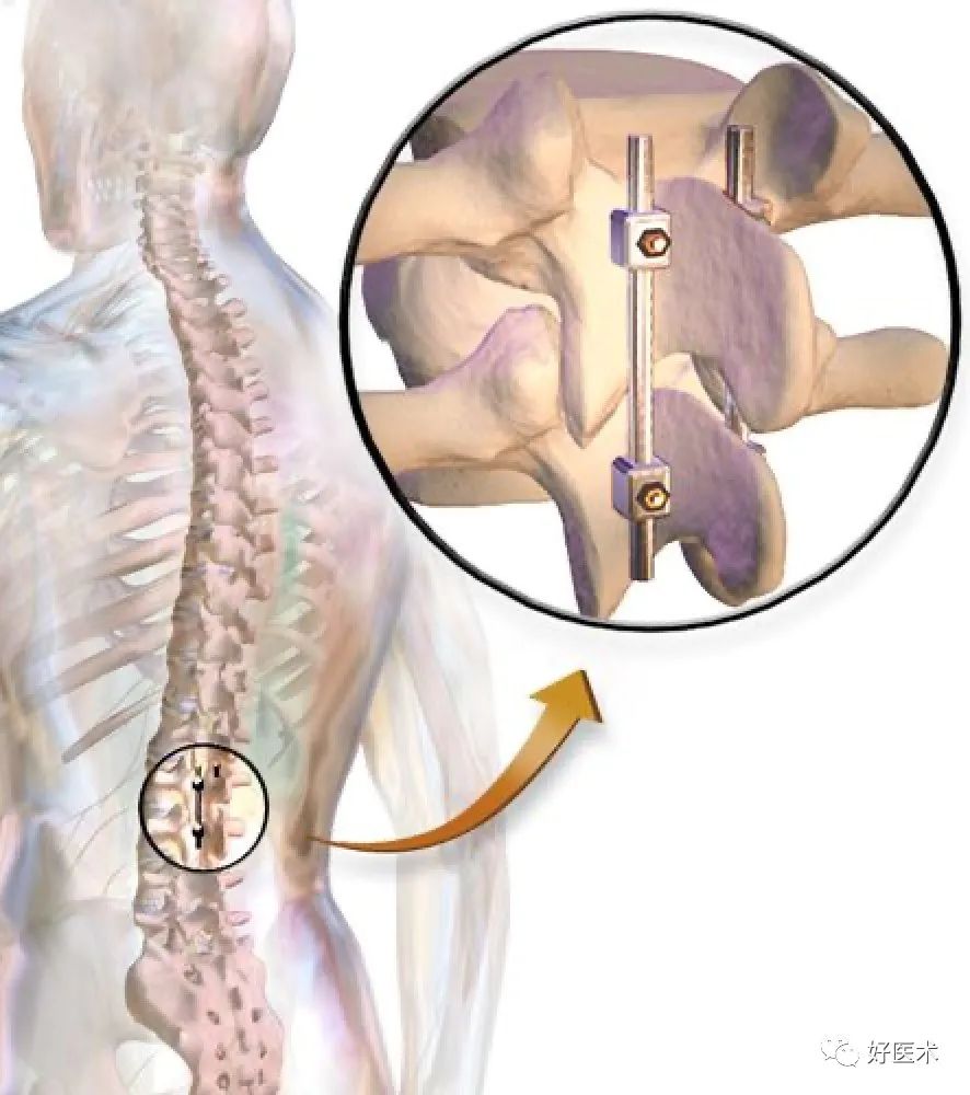 进阶必读，脊柱骨折脱位的三大处理方法！