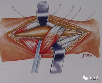 (20)桡骨近段1/3:前侧入路切口:起自肘前横纹沿肱桡肌内侧缘走形,在