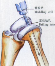 给你整理好了！人工膝关节置换手术步骤全解