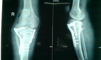 保膝治疗之—胫骨高位截骨术