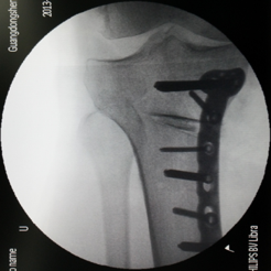 保膝治疗之—胫骨高位截骨术