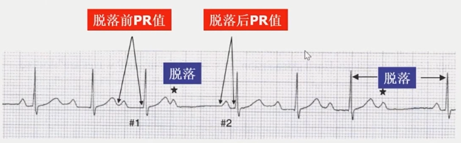 从浅入深，心脏阻滞部位确定超详解