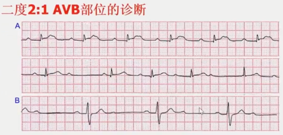 从浅入深，心脏阻滞部位确定超详解