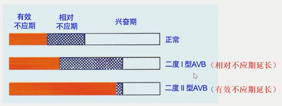 从浅入深，心脏阻滞部位确定超详解