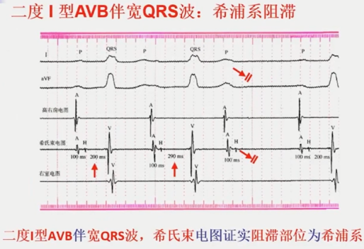 从浅入深，心脏阻滞部位确定超详解