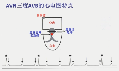 从浅入深，心脏阻滞部位确定超详解