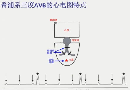 从浅入深，心脏阻滞部位确定超详解