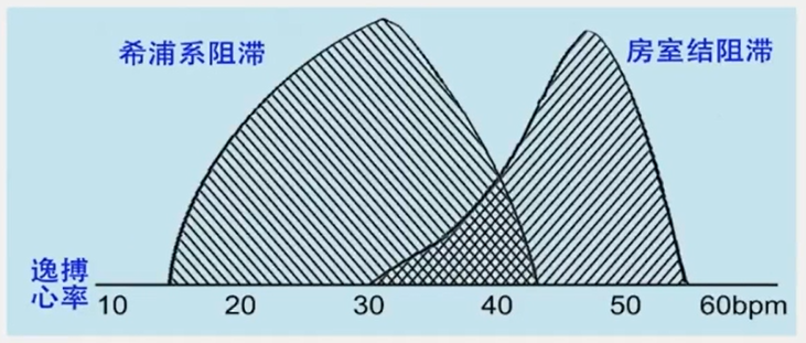 从浅入深，心脏阻滞部位确定超详解