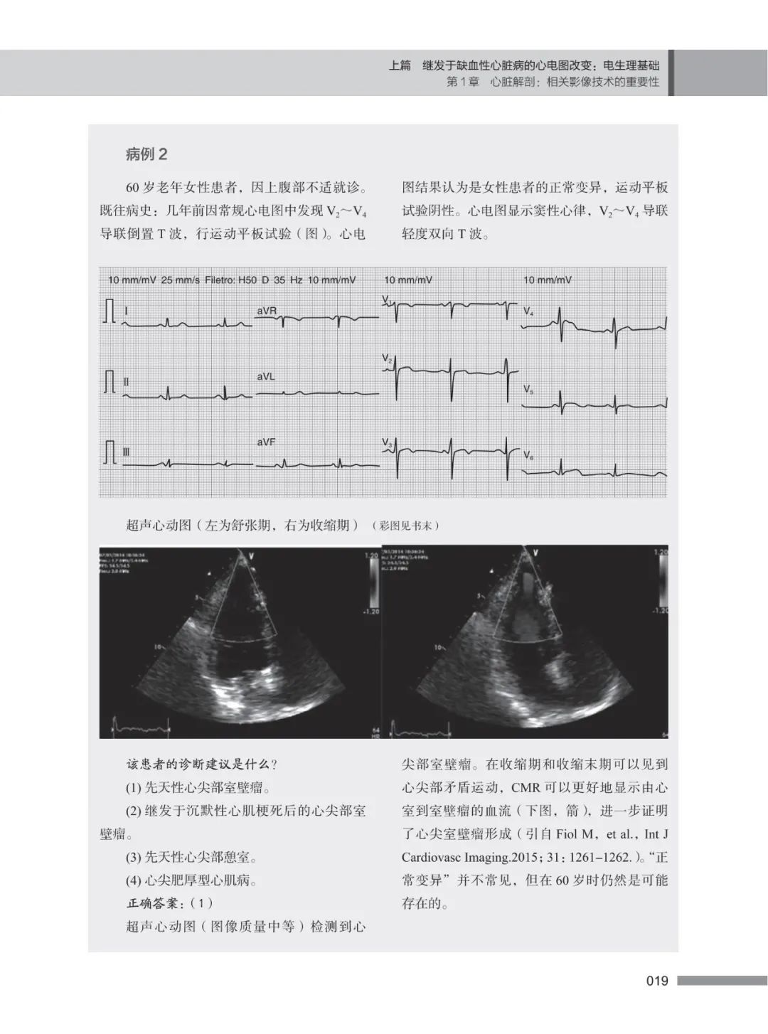 冠状动脉介入医生案头必备《缺血性心脏病心电图》