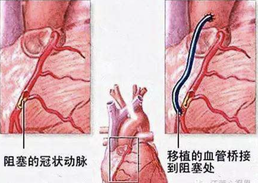 稳定型心绞痛如何诊治？看权威指南如何推荐~