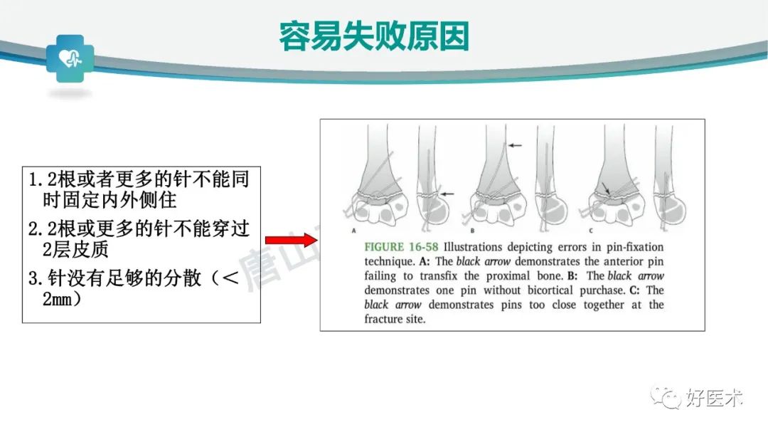 儿童肱骨髁上骨折的诊断与治疗