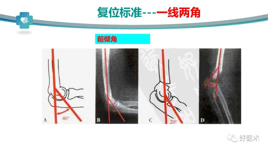 儿童肱骨髁上骨折的诊断与治疗