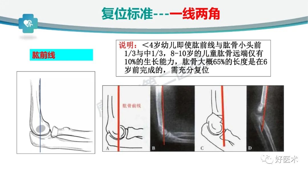 儿童肱骨髁上骨折的诊断与治疗