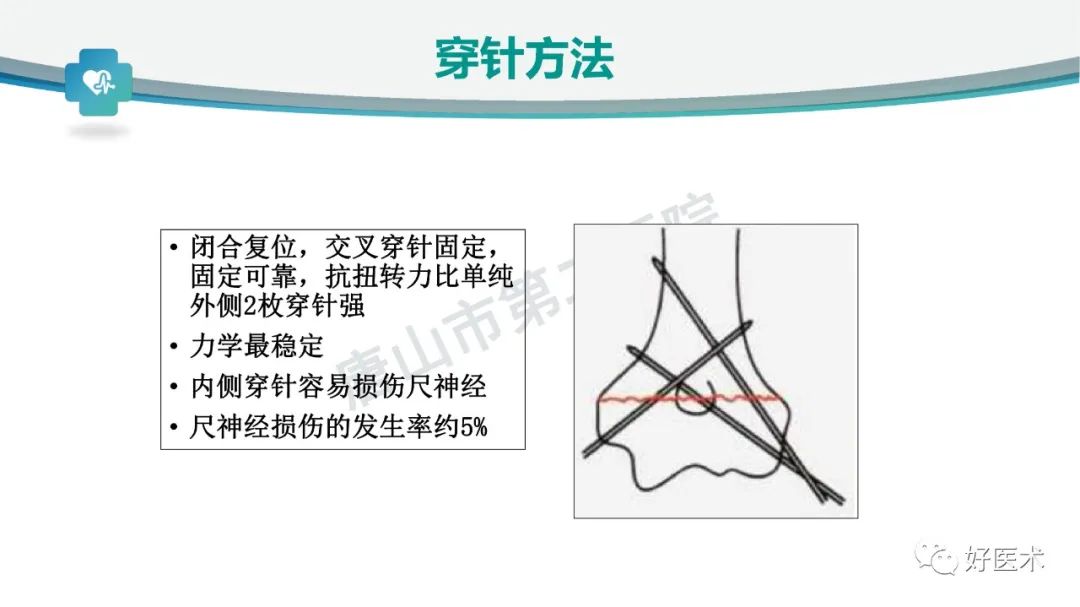 儿童肱骨髁上骨折的诊断与治疗