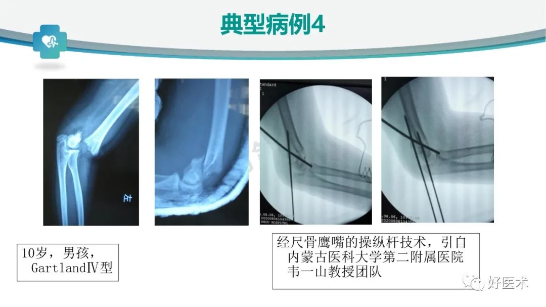 儿童肱骨髁上骨折的诊断与治疗